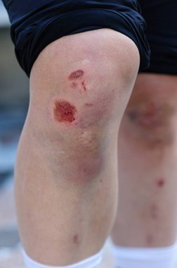 Spor sakatlığı, dizleri yaralı bir kaykaycı.