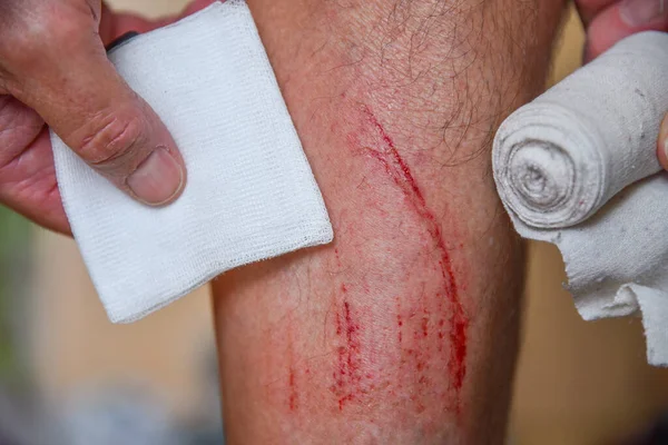 First Aid Abrasion Accident Injury Abrasion — Stok fotoğraf