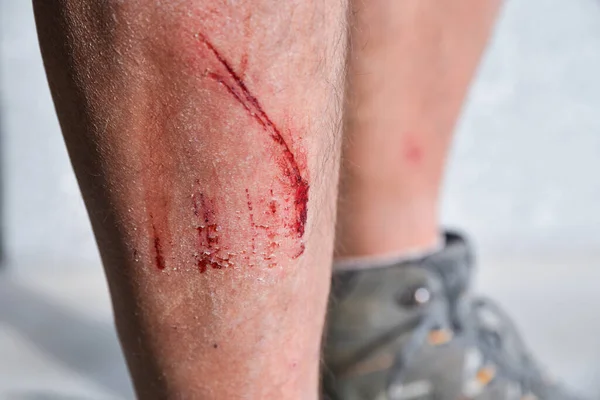 Severe Abrasion Shin Accident Skin Injury Wound — Stock Photo, Image