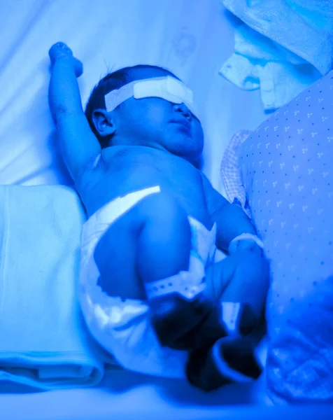 Pasgeboren baby onder blauw licht voor geelzucht behandeling — Stockfoto
