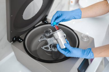 Beautician doctor's hands put test tube with blood in centrifuge container. Rejuvenation plasmolifting procedure