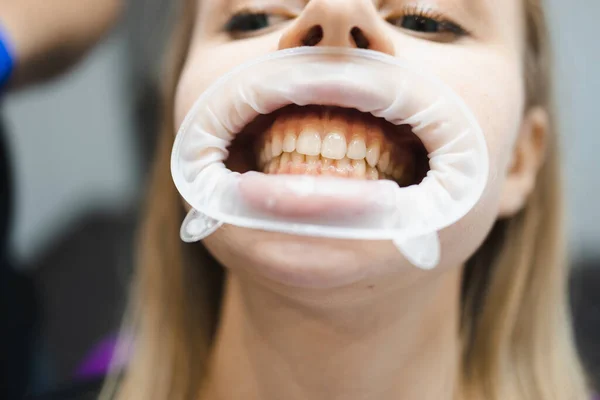 Diş Hekimliğinde Yanak Genişleticisi Olan Bir Kadın Hastanın Ağzına Yakın — Stok fotoğraf