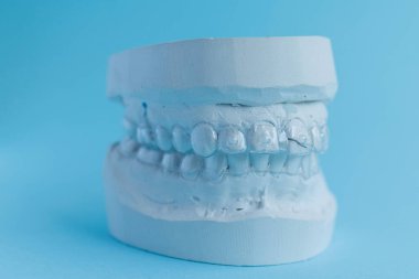 Gypsum mould of human jaw with transparent aligner, invisible retainer or orthodontic silicone trainer on blue background