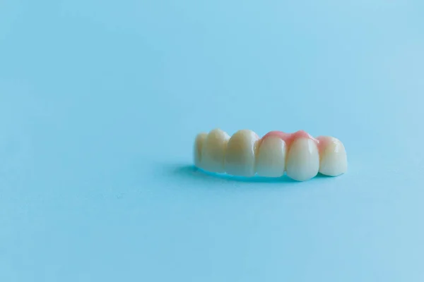Artificial teeth on a blue background, dental crowns. Concept of dental implantation and restoration