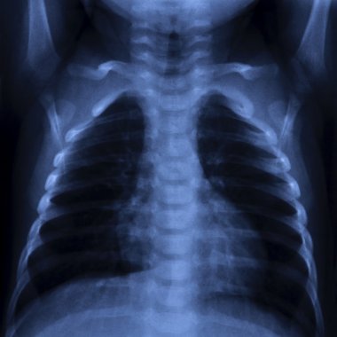 Toraks X Ray
