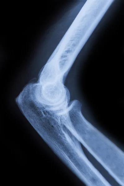 Elbow X Ray — Stock Photo, Image