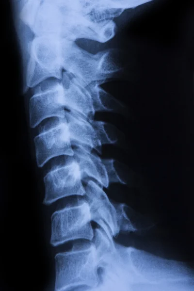 Radiografía de columna vertebral —  Fotos de Stock