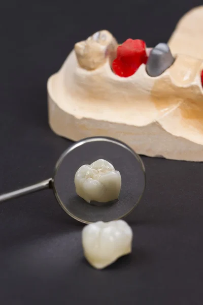 Ceramic crown for molar teeth — Stock Photo, Image