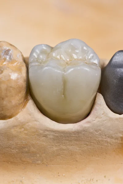 Corona di ceramica per denti molari — Foto Stock