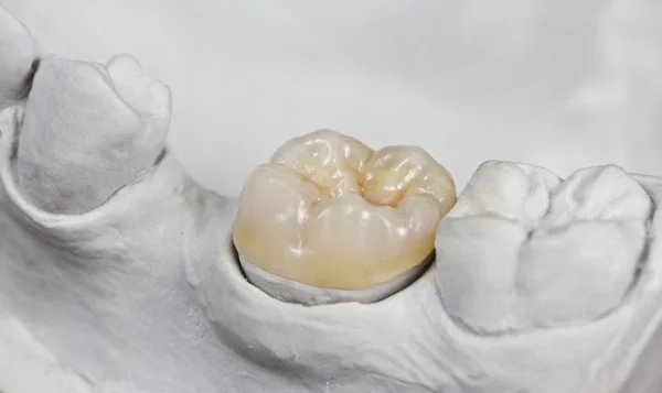 Dental onlay on a cast model — Stock Photo, Image