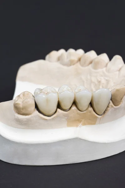 Ponte cerâmica dental — Fotografia de Stock