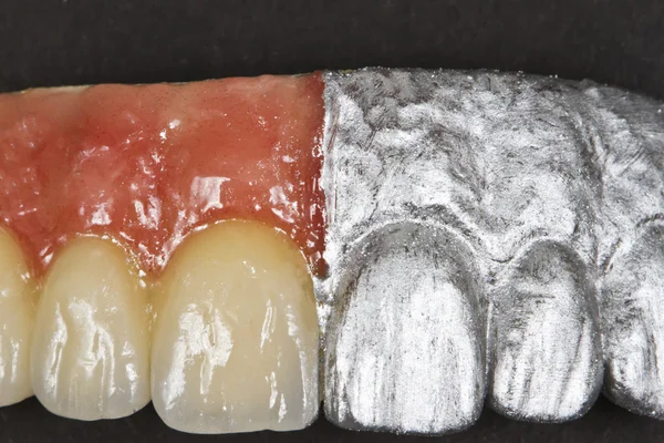 Denti e gengive anteriori in ceramica — Foto Stock