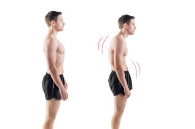 Man with impaired posture position defect scoliosis and ideal bearing clipart