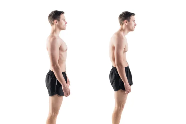 Man with impaired posture position defect scoliosis and ideal bearing — Stock Photo, Image