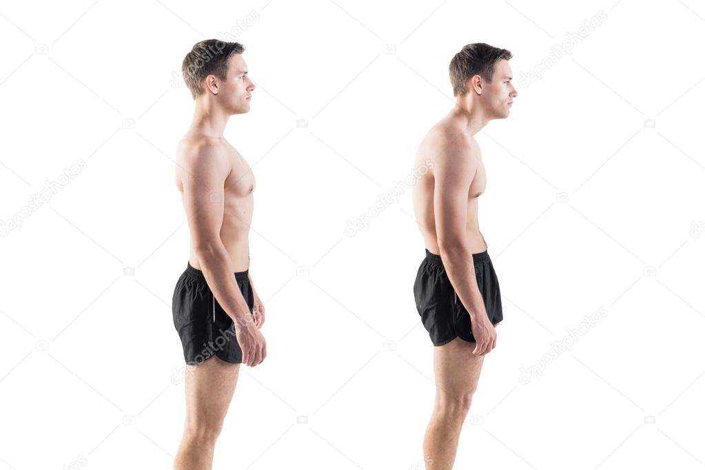 Man with impaired posture position defect scoliosis and ideal bearing