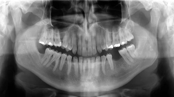 Panoramic x-ray radiograph of teeth — Stock Photo, Image