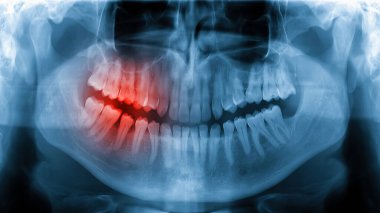 Diş ağrısı x-ray röntgeni, diş sinirlerinde ağrı olduğunu gösteriyor.