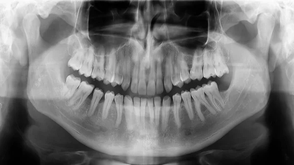 Immagine Radiografia Raggi Che Mostra Mandibola Umana Denti — Foto Stock