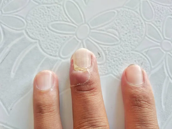 Human Finger Physical Injury White Background — 图库照片