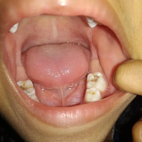 close-up of a young boy's teeth.