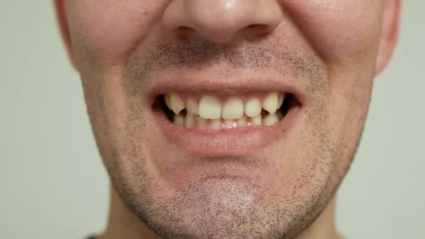 Man Shows Yellow Crooked Worn Teeth Close View Bad Condition — Stock Video