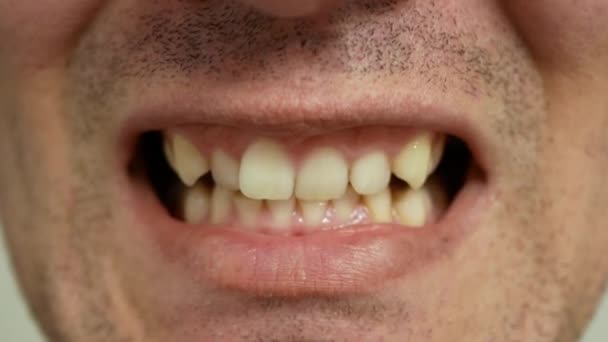 Muž Ukazuje Žluté Křivé Opotřebované Zuby Zavřít Pohled Špatný Stav — Stock video