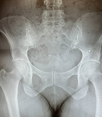X-ray of a middle aged woman's hip