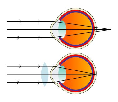 Illustration of hyperopic eye with comparison to normal eye clipart