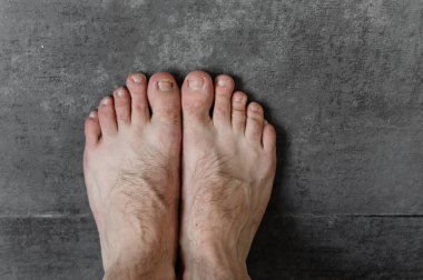 Mantarlı erkek ayakları ve koyu bir arka planda yakın plan dermatolojik problemler. Kıllı ayaklar. Ayak tırnağı sorunu. ayak derisi problemi