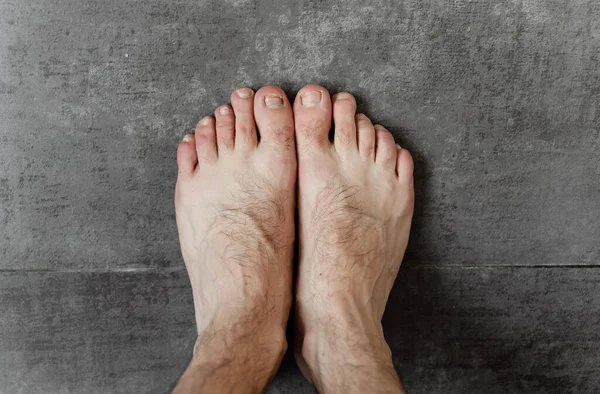 Mantarlı erkek ayakları ve koyu bir arka planda yakın plan dermatolojik problemler. Kıllı ayaklar. Ayak tırnağı sorunu. ayak derisi problemi