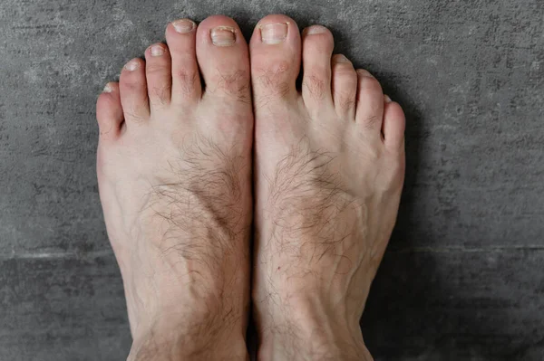 Mužské Nohy Houbou Různé Kožní Problémy Zblízka Tmavém Pozadí Chlupaté — Stock fotografie