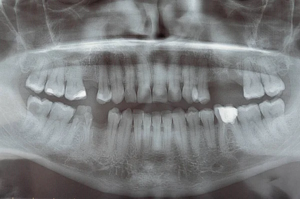 Panoramiczne Prześwietlenie Zębów Problemy Zębami Klinika Dentystyczna Zbliżenie Leczenie Schorowanych — Zdjęcie stockowe