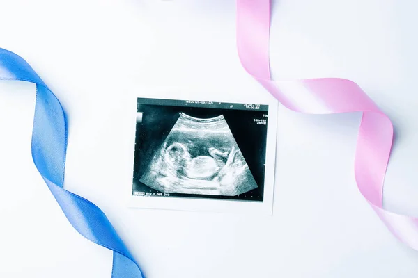Ultrasound Picture Pregnant Baby Photo Blue Pink Ribbon Ultrasound Pregnancy — Stockfoto