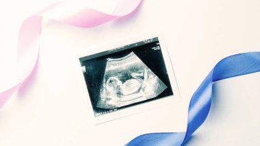 Ultrason görüntüsü hamile bebek fotoğrafı. Mavi, pembe kurdeleli, beyaz arka planda ultrasonlu hamilelik fotoğrafı. Hamilelik kavramı, annelik, bebek doğumu beklentisi