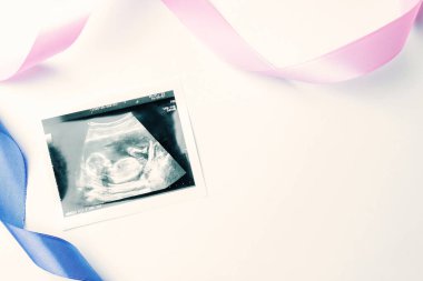 Ultrason görüntüsü hamile bebek fotoğrafı. Mavi, pembe kurdeleli, beyaz arka planda ultrasonlu hamilelik fotoğrafı. Hamilelik kavramı, annelik, bebek doğumu beklentisi