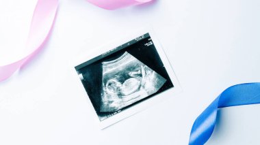 Ultrason fotoğrafı hamile bebek fotoğrafı. Beyaz arka planda ultrason görüntüsü olan mavi, pembe bir kurdele. Hamilelik, ilaç, eczacılık, sağlık ve insan konsepti