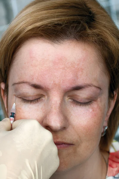 Botox injection in the eye corner — Stock Photo, Image