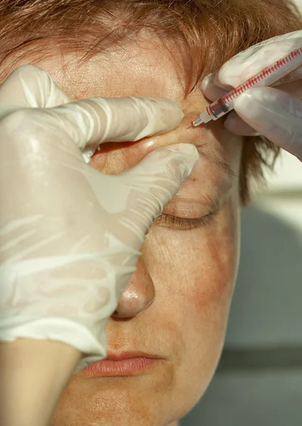 Botox injection in the superciliary arch — Stock Photo, Image