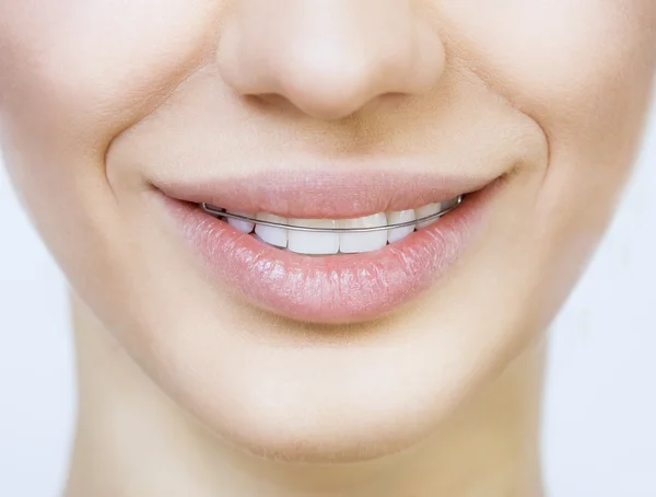 Beautiful smiling girl with retainer for teeth — Stock Photo, Image