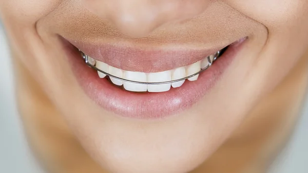 Menina sorridente bonita com retentor para dentes — Fotografia de Stock