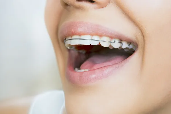 Schöne lächelnde Mädchen mit Halter für Zähne lizenzfreie Stockbilder