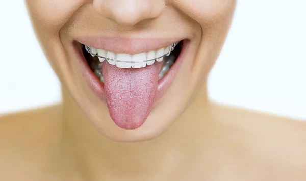 Ragazza con fermo per i denti attaccare la lingua fuori — Foto Stock