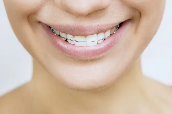 Retentor para dentes - Menina sorridente bonita com retentor para te — Fotografia de Stock