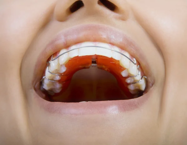 Primer plano de dientes sonrientes con retenedor — Foto de Stock