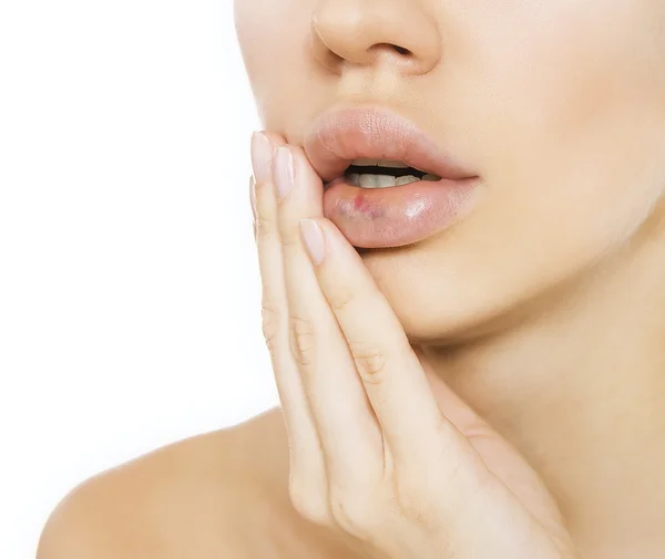 Real lip bruise after injection — Stock Photo, Image