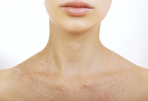 Female neck after hyaluronic injection (collagen biorevitalizati — Stock Photo, Image