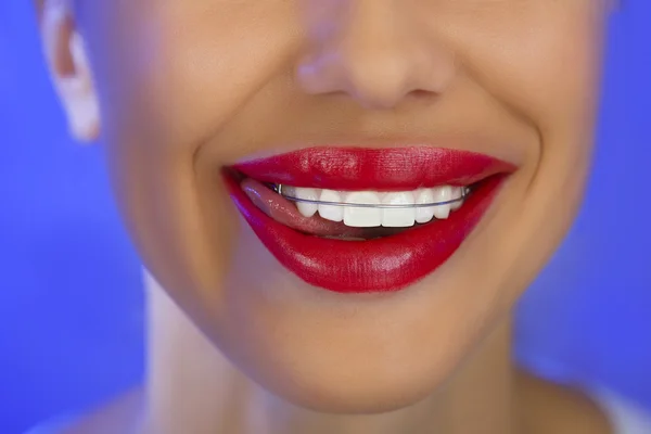 Bella ragazza sorridente con fermo per i denti, primo piano — Foto Stock