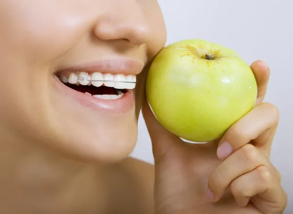 Lächelndes Mädchen mit Halterung für Zähne und Apfel — Stockfoto