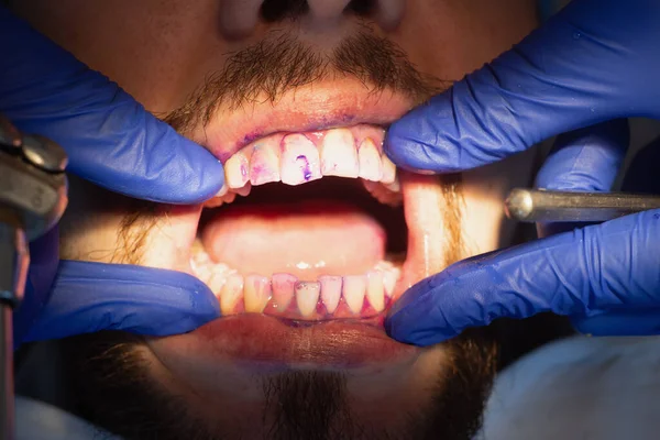 Επαγγελματική στοματική υγιεινή και καθαρισμός δοντιών. Εφαρμόζω το τζελ στα δόντια. Πρόληψη της τερηδόνας και των ασθενειών των ούλων. Ο συσπειρωτήρας στο στόμα. Άνω όψη — Φωτογραφία Αρχείου