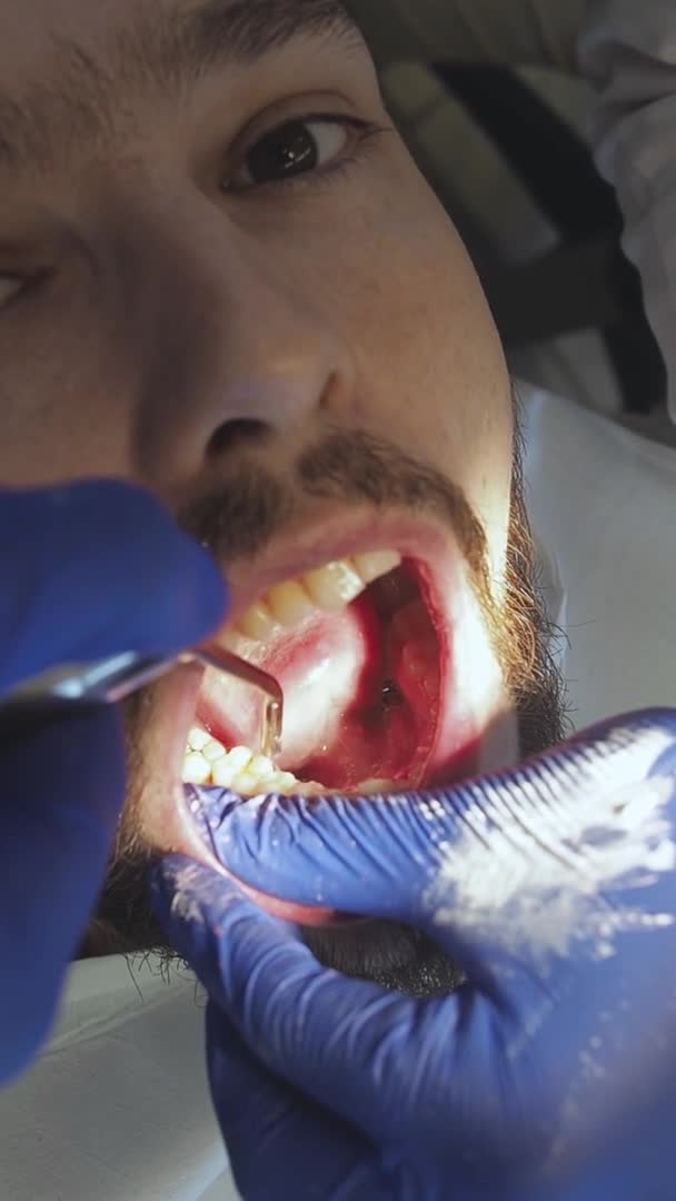 The dentist conducts oral hygiene to the patient with ultrasound. Cleaning plaque and tartar in a dental clinic. — Stock Video